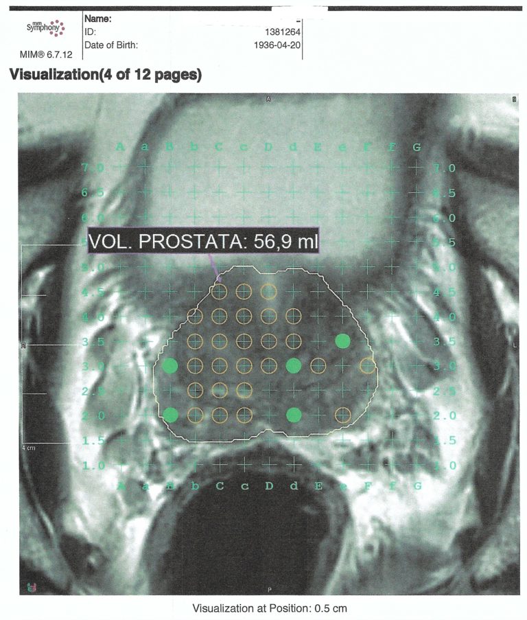 Biopsia De Próstata Por Fusión La Herramienta Clave En La Detección